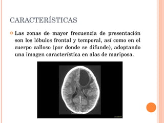 CARACTERÍSTICAS Las zonas de mayor frecuencia de presentación son los lóbulos frontal y temporal, así como en el cuerpo calloso (por donde se difunde), adoptando una imagen característica en alas de mariposa. 