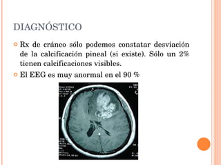 DIAGNÓSTICO Rx de cráneo sólo podemos constatar desviación de la calcificación pineal (si existe). Sólo un 2% tienen calcificaciones visibles. El EEG es muy anormal en el 90 % 