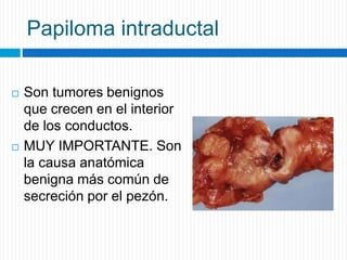 Papiloma intraductal
 Son tumores benignos
que crecen en el interior
de los conductos.
 MUY IMPORTANTE. Son
la causa anatómica
benigna más común de
secreción por el pezón.
 