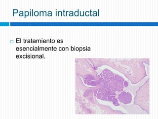 Papiloma intraductal
 El tratamiento es
esencialmente con biopsia
excisional.
 