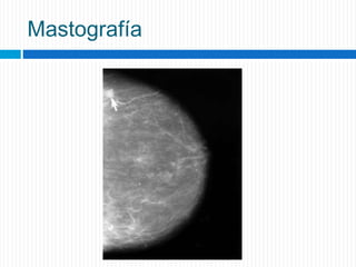Mastografía
 