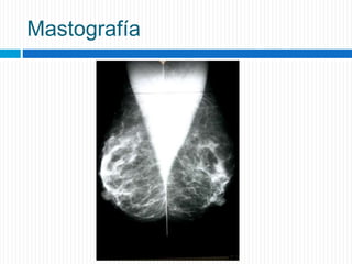 Mastografía
 