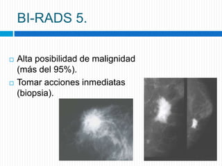 BI-RADS 5.
 Alta posibilidad de malignidad
(más del 95%).
 Tomar acciones inmediatas
(biopsia).
 