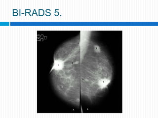 BI-RADS 5.
 