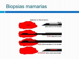 Biopsias mamarias
 