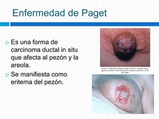 Enfermedad de Paget
 Es una forma de
carcinoma ductal in situ
que afecta al pezón y la
areola.
 Se manifiesta como
eritema del pezón.
 