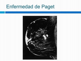 Enfermedad de Paget
 