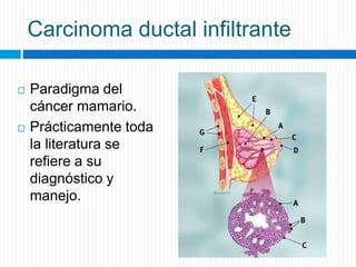 Carcinoma ductal infiltrante
 Paradigma del
cáncer mamario.
 Prácticamente toda
la literatura se
refiere a su
diagnóstico y
manejo.
 
