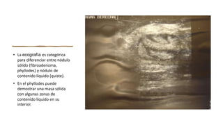 • La ecografía es categórica
para diferenciar entre nódulo
sólido (fibroadenoma,
phyllodes) y nódulo de
contenido líquido (quiste).
• En el phyllodes puede
demostrar una masa sólida
con algunas zonas de
contenido líquido en su
interior.
 
