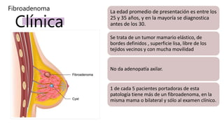 Clínica
La edad promedio de presentación es entre los
25 y 35 años, y en la mayoría se diagnostica
antes de los 30.
Se trata de un tumor mamario elástico, de
bordes definidos , superficie lisa, libre de los
tejidos vecinos y con mucha movilidad
No da adenopatía axilar.
1 de cada 5 pacientes portadoras de esta
patología tiene más de un fibroadenoma, en la
misma mama o bilateral y sólo al examen clínico.
Fibroadenoma
 
