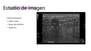 Estudio de imagen
USG (Gold Standard)
• Nódulo sólido
• Bordes bien definidos
• Hipoecoico
 