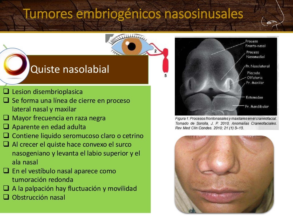 Tumores de nariz y senos paranasales