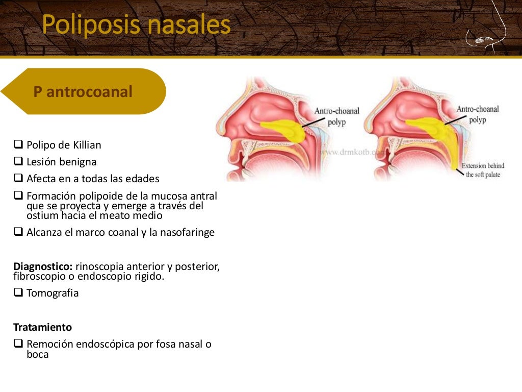 Tumores de nariz y senos paranasales