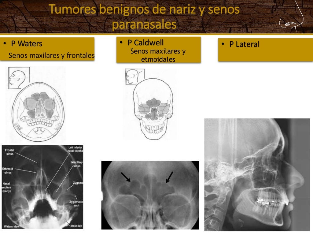 Tumores de nariz y senos paranasales