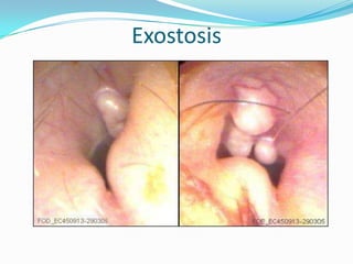 Exostosis