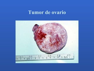 Tumor de ovario 