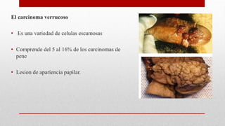 El carcinoma verrucoso
• Es una variedad de celulas escamosas
• Comprende del 5 al 16% de los carcinomas de
pene
• Lesion de apariencia papilar.
 