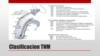 Clasificacion TNM
 