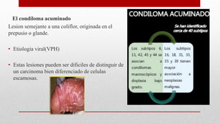 El condiloma acuminado
Lesion semejante a una coliflor, originada en el
prepusio o glande.
• Etiologia viral(VPH)
• Estas lesiones pueden ser dificiles de distinguir de
un carcinoma bien diferenciado de celulas
escamosas.
 