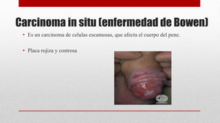 Carcinoma in situ (enfermedad de Bowen)
• Es un carcinoma de celulas escamosas, que afecta el cuerpo del pene.
• Placa rojiza y costrosa
 