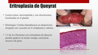 Eritroplasia de Queyrat
• Lesion rojiza, aterciopelada y con ulceraciones,
localizadas en el glande.
• Histologia: Celulas hiperplasicas en disposicion
irregular con vacuolas en el citoplasma y mitosis.
• 13 de los Pacientes con eritroplasia de Queyrat
pueden padecer al mismo tiempo carcinoma
invasivo de pene.
 