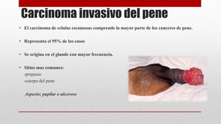 Carcinoma invasivo del pene
• El carcinoma de celulas escamosas comprende la mayor parte de los canceres de pene.
• Representa el 95% de los casos
• Se origina en el glande con mayor frecuencia.
• Sitios mas comunes:
-prepusio
-cuerpo del pene
Aspecto: papilar o ulceroso
 