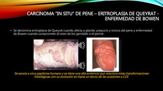 TUMORES DE PENE CATEDRA DE UROLOGIA | PPTX
