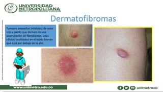 Dermatofibromas
Tumores pequeños (nódulos) de color
rojo a pardo que derivan de una
acumulación de fibroblastos, unas
células localizadas en el tejido blando
que está por debajo de la piel.
 