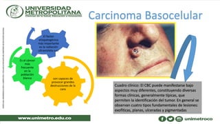 Carcinoma Basocelular
son capaces de
provocar grandes
destrucciones de la
cara
Es el cáncer
más
frecuente
en la
población
blanca
El factor
etiopatogénico
más importante
es la radiación
ultravioleta (UV).
Cuadro clínico: El CBC puede manifestarse bajo
aspectos muy diferentes, constituyendo diversas
formas clínicas, generalmente típicas, que
permiten la identificación del tumor. En general se
observan cuatro tipos fundamentales de lesiones:
exofíticas, planas, ulceradas y pigmentadas
 