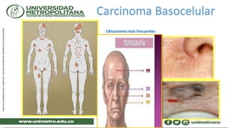 Carcinoma Basocelular
Ubicaciones más frecuentes
 