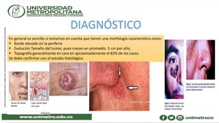 DIAGNÓSTICO
En general es sencillo si tomamos en cuenta que tienen una morfología característica como:
 Borde elevado en la periferia
 Evolución Tamaño del tumor, pues crecen en promedio .5 cm por año,
 Topografía generalmente en cara en aproximadamente el 82% de los casos.
Se debe confirmar con el estudio histológico.
 