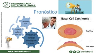 Pronóstico
la mayoría de estos
tumores son
curables, sin
embargo las
formas infiltrantes
tienen tendencia a
la recidiva.
bajo riesgo
de
metástasis
Aprox. 3%
Crecimiento
lento
 