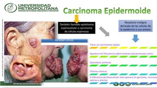 También llamado epitelioma
espinocelular o carcinoma
de células espinosas
Neoplasia maligna
derivada de las células de
la epidermis o sus anexos
Tiene un crecimiento rápido
Aparece con frecuencia sobre lesiones precancerosas como:
Queratosis actínicas
Ùlceras crónicas
A diferencia del basocelular éste aparece en genitales, mucosas
palmas y plantas
 