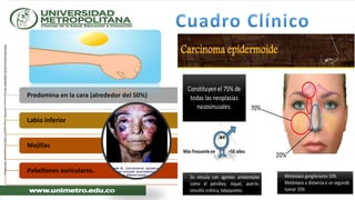 Predomina en la cara (alrededor del 50%)
Labio inferior
Mejillas
Pabellones auriculares.
 