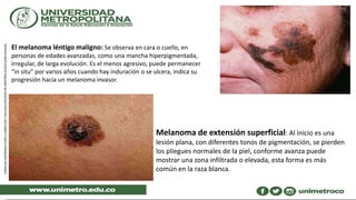 El melanoma léntigo maligno: Se observa en cara o cuello, en
personas de edades avanzadas, como una mancha hiperpigmentada,
irregular, de larga evolución. Es el menos agresivo, puede permanecer
“in situ” por varios años cuando hay induración o se ulcera, indica su
progresión hacia un melanoma invasor.
Melanoma de extensión superficial: Al inicio es una
lesión plana, con diferentes tonos de pigmentación, se pierden
los pliegues normales de la piel, conforme avanza puede
mostrar una zona infiltrada o elevada, esta forma es más
común en la raza blanca.
 