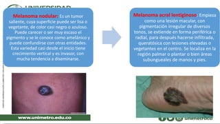 Melanoma nodular: Es un tumor
saliente, cuya superficie puede ser lisa o
vegetante, de color casi negro o azuloso.
Puede carecer o ser muy escaso el
pigmento y se le conoce como amelánico y
puede confundirse con otras entidades.
Esta variedad casi desde el inicio tiene
crecimiento vertical y es invasor, con
mucha tendencia a diseminarse.
Melanoma acral lentiginoso: Empieza
como una lesión macular, con
pigmentación irregular de diversos
tonos, se extiende en forma periférica o
radial, para después hacerse infiltrada,
queratósica con lesiones elevadas o
vegetantes en el centro. Se localiza en la
región palmar o plantar o bien áreas
subungueales de manos y pies.
 