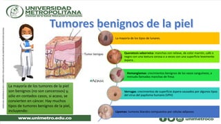 La mayoría de los tumores de la piel
son benignos (no son cancerosos) y,
sólo en contados casos, si acaso, se
convierten en cáncer. Hay muchos
tipos de tumores benignos de la piel,
incluyendo:
La mayoría de los tipos de lunares.
Queratosis seborreica: manchas con relieve, de color marrón, café o
negro con una textura cerosa o a veces con una superficie levemente
áspera .
Hemangiomas: crecimientos benignos de los vasos sanguíneos, a
menudo llamados manchas de fresa
Verrugas: crecimientos de superficie áspera causados por algunos tipos
del virus del papiloma humano (VPH)
Lipomas: tumores blandos compuestos por células adiposas
 