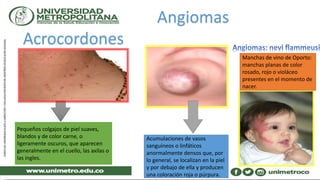 Acrocordones
Pequeños colgajos de piel suaves,
blandos y de color carne, o
ligeramente oscuros, que aparecen
generalmente en el cuello, las axilas o
las ingles.
Angiomas
Acumulaciones de vasos
sanguíneos o linfáticos
anormalmente densos que, por
lo general, se localizan en la piel
y por debajo de ella y producen
una coloración roja o púrpura.
Manchas de vino de Oporto:
manchas planas de color
rosado, rojo o violáceo
presentes en el momento de
nacer.
 