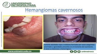 Tumores abultados rojos o violáceos formados por vasos sanguíneos
anormales y agrandados presentes en el momento del nacimiento.
A veces se dolorosos y hemorrágicos,
 