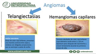 Angiomas
arañas vasculares
Áreas de color rojo brillante, presentan
una mancha central entre rojiza y
violácea con delgadas proyecciones
que se asemejan a patas de araña.
Telangiectasias Hemangiomas capilares
Tumores abultados de color rojo brillante
cuyo diámetro oscila entre 1 y 10 cm.
Aparecen poco después del nacimiento y
crecen lentamente durante los primeros
meses de vida.
 