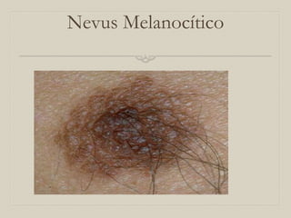 Nevus Melanocítico

 
