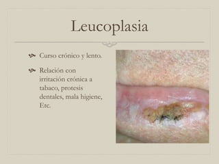 Leucoplasia
 Curso crónico y lento.
 Relación con
irritación crónica a
tabaco, protesis
dentales, mala higiene,
Etc.

 