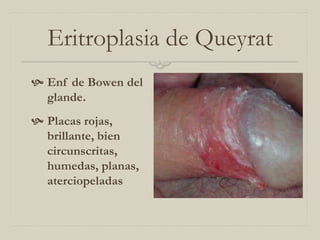 Eritroplasia de Queyrat
 Enf de Bowen del
glande.
 Placas rojas,
brillante, bien
circunscritas,
humedas, planas,
aterciopeladas

 