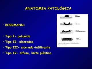 ANATOMIA PATOLÓGICA



• BORRMANN:


• Tipo I- polipóide
• Tipo II- ulcerados
• Tipo III- ulcerado-infiltrante
• Tipo IV- difuso, linite plástica
 