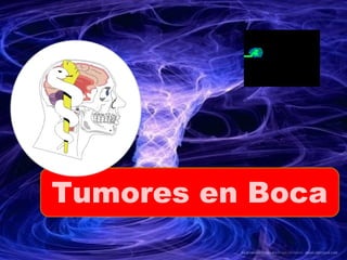 Tumores en Boca
 