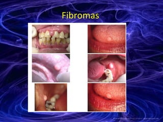 Fibromas  