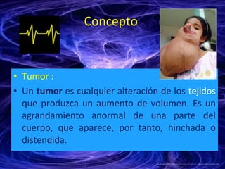 Concepto  <ul><li>Tumor : </li></ul><ul><li>Un  tumor  es cualquier alteración de los  tejidos  que produzca un aumento de...