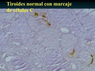 Antonio Ferrández Izquierdo
Tiroides normal con marcaje
de células C
 