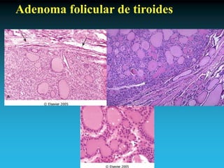 Antonio Ferrández Izquierdo
Adenoma folicular de tiroides
 