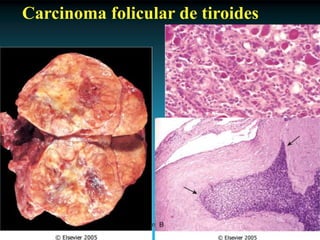 Antonio Ferrández Izquierdo
Carcinoma folicular de tiroides
 